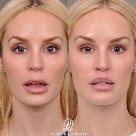 Moddified Upper Lip Lift with Deep Release with Infra Brow Filler - Front