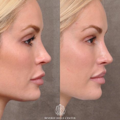 Moddified Upper Lip Lift with Deep Release with Infra Brow Filler - Right Side