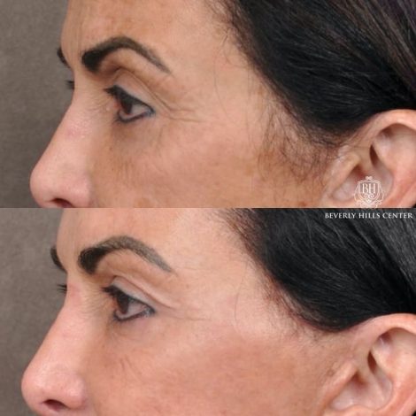 AuraLyft with Buccal Fat Transfer - Left Side