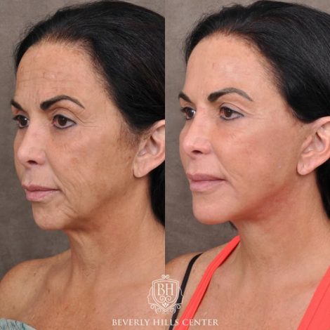 AuraLyft with Buccal Fat Transfer - Left Side