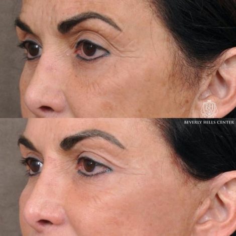 AuraLyft with Buccal Fat Transfer - Left Side