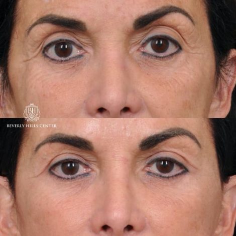 AuraLyft with Buccal Fat Transfer - Front