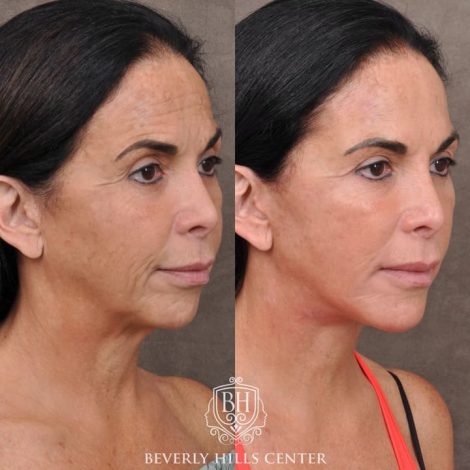 AuraLyft with Buccal Fat Transfer - Right Side