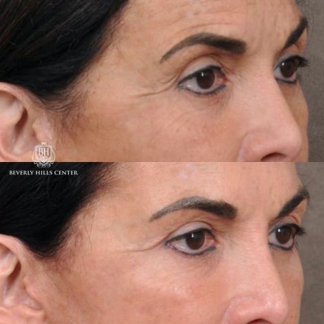AuraLyft with Buccal Fat Transfer - Right Side