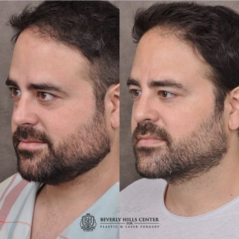 Beverly Hills Center Male Patient Before Rhinoplasty, profound RF treatment and a PHAT treatment.