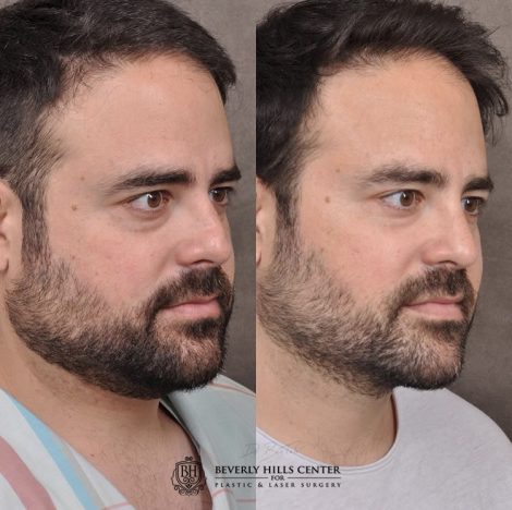 Beverly Hills Center Male Patient Before Rhinoplasty, profound RF treatment and a PHAT treatment.