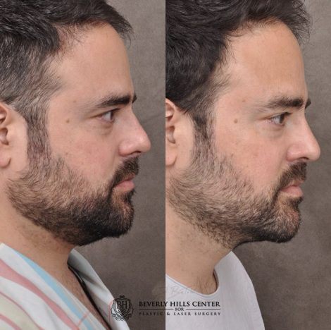 Beverly Hills Center Male Patient Before Rhinoplasty, profound RF treatment and a PHAT treatment.