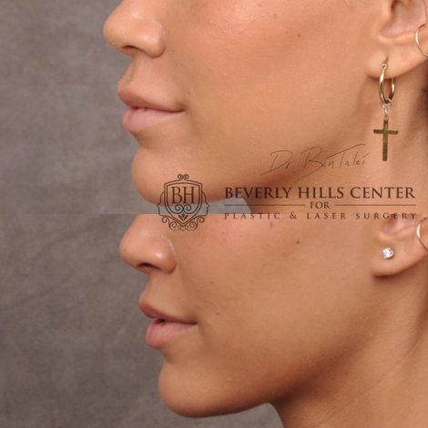 Deep Plane Modified Upper Lip Lift instead of fillers - Left Side