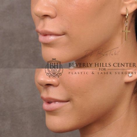 Deep Plane Modified Upper Lip Lift instead of fillers - Left Side
