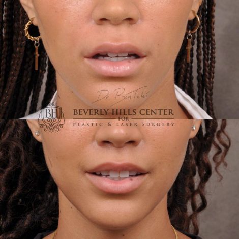 Deep Plane Modified Upper Lip Lift instead of fillers - Front