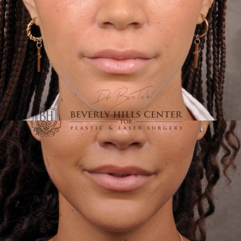 Deep Plane Modified Upper Lip Lift instead of fillers - Front