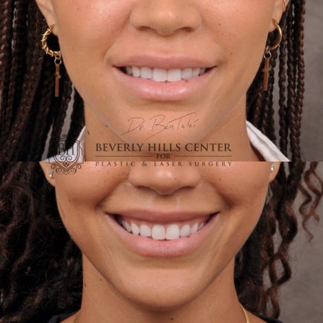 Deep Plane Modified Upper Lip Lift instead of fillers - Front