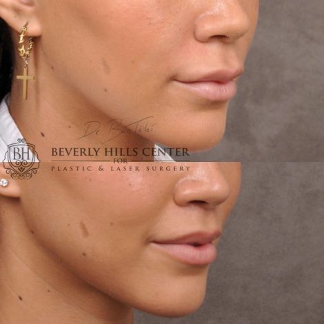 Deep Plane Modified Upper Lip Lift instead of fillers - Right Side