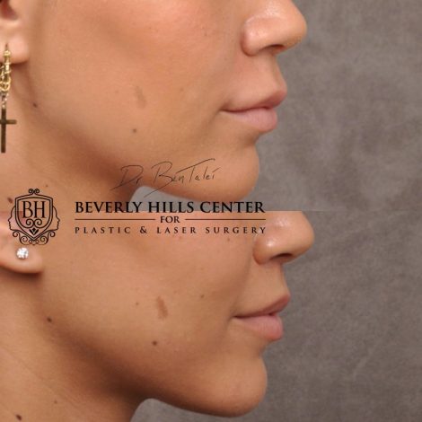 Deep Plane Modified Upper Lip Lift instead of fillers - Right Side