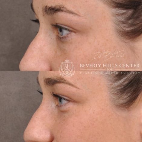 Lower Eyelid Blepharoplasty - Left Side