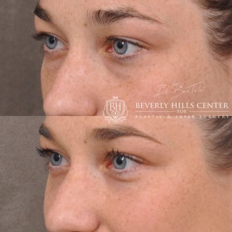Lower Eyelid Blepharoplasty - Left Side