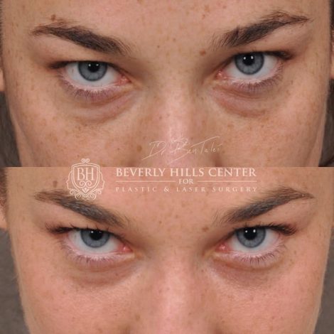 Lower Eyelid Blepharoplasty - Front