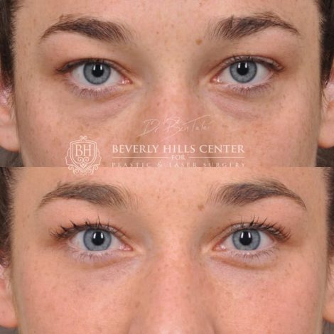 Lower Eyelid Blepharoplasty - Front