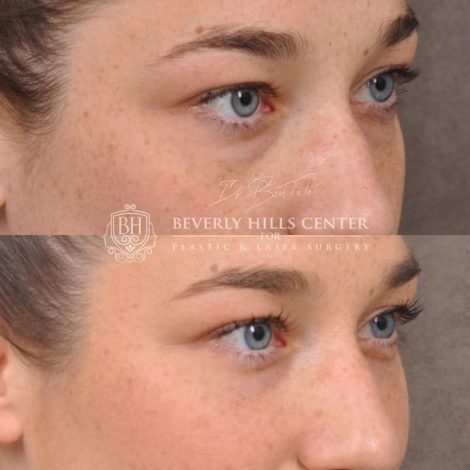 Lower Eyelid Blepharoplasty - Right Side