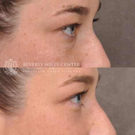 Lower Eyelid Blepharoplasty - Right Side