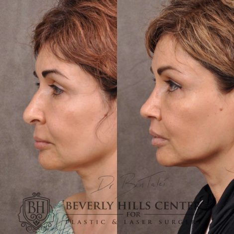 Natural Rhinoplasty and Deep Plane Modified Upper Lip Lift - Left side