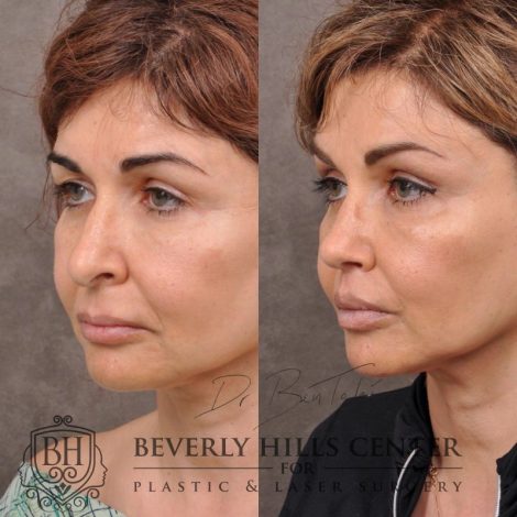Natural Rhinoplasty and Deep Plane Modified Upper Lip Lift - left side