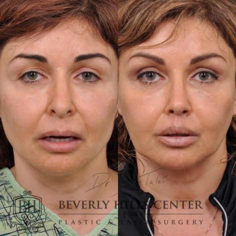 Natural Rhinoplasty and Deep Plane Modified Upper Lip Lift - Front