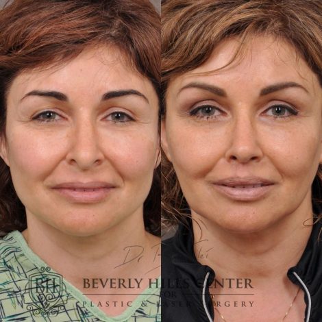 Natural Rhinoplasty and Deep Plane Modified Upper Lip Lift - Front