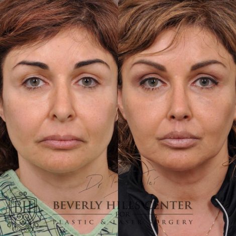 Natural Rhinoplasty and Deep Plane Modified Upper Lip Lift - Front