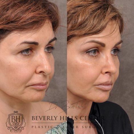 Natural Rhinoplasty and Deep Plane Modified Upper Lip Lift - Right side