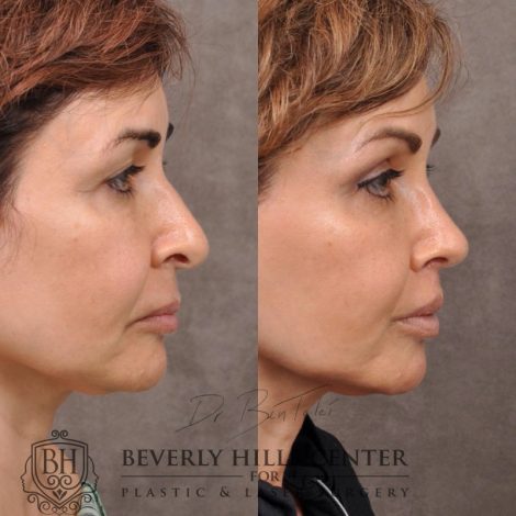 Natural Rhinoplasty and Deep Plane Modified Upper Lip Lift - Right side