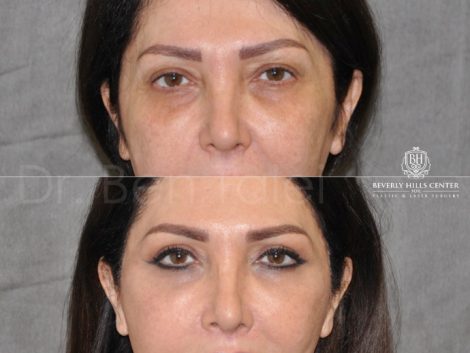 Lower & Upper Eyelid Rejuvenation - Front
