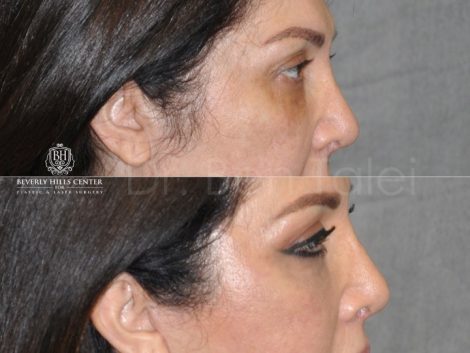 Lower & Upper Eyelid Rejuvenation - Right Side