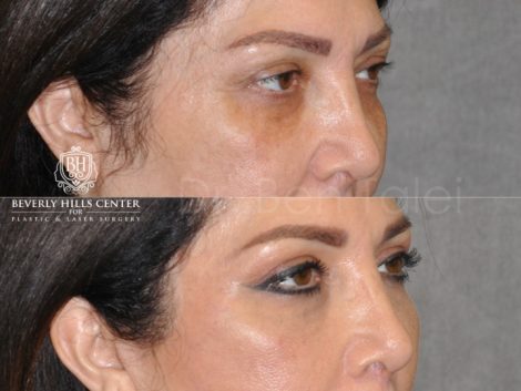 Lower & Upper Eyelid Rejuvenation - Right Side