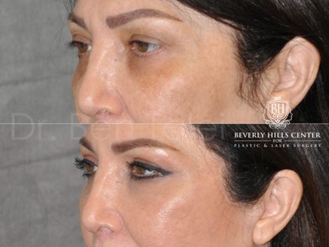 Lower & Upper Eyelid Rejuvenation - Left Side