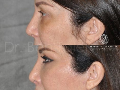 Lower & Upper Eyelid Rejuvenation - Left Side