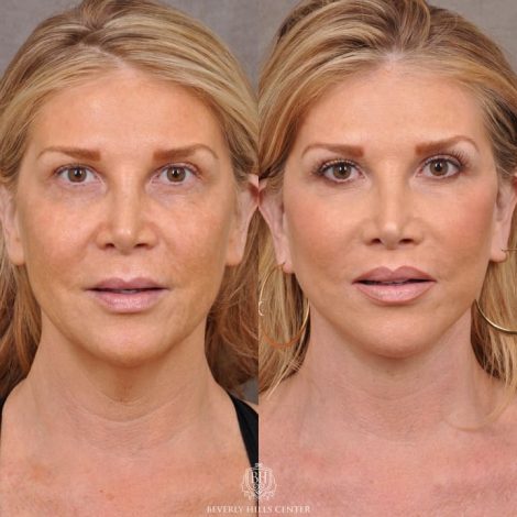 Auralyft & Deep Plane Upper Lip Lift - Front