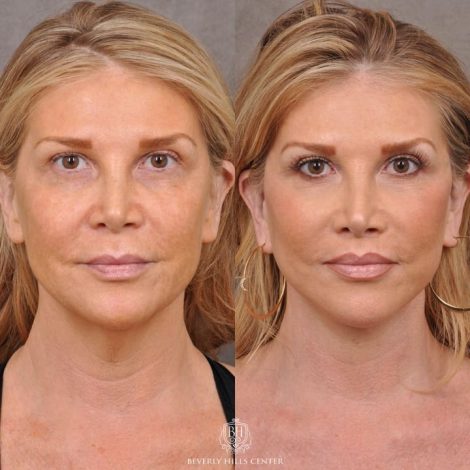 Auralyft & Deep Plane Upper Lip Lift - Front