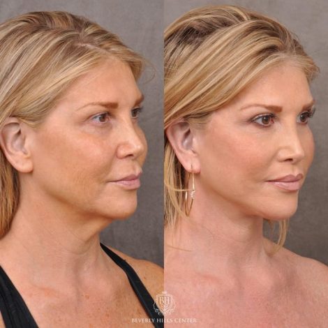 Auralyft & Deep Plane Upper Lip Lift - Left Side