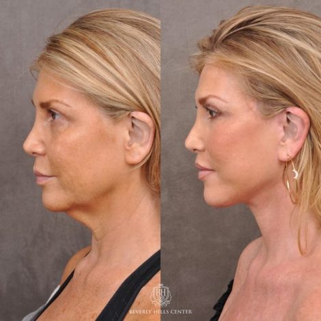 Auralyft & Deep Plane Upper Lip Lift - Right Side