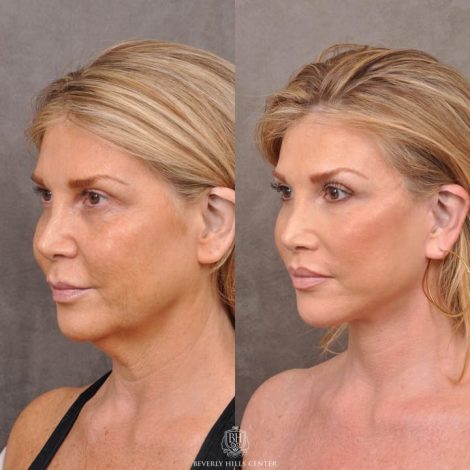Auralyft & Deep Plane Upper Lip Lift - Right Side