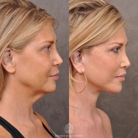Auralyft & Deep Plane Upper Lip Lift - Left Side