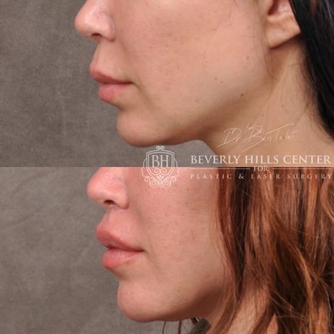 Deep Plane Lip Lift AKA Modified Upper Lip lift - Left Side