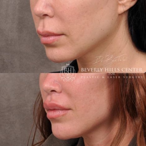 Deep Plane Lip Lift AKA Modified Upper Lip lift - Left Side