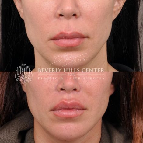 Deep Plane Lip Lift AKA Modified Upper Lip lift - Front