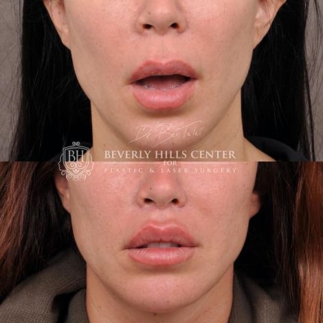 Deep Plane Lip Lift AKA Modified Upper Lip lift - Front