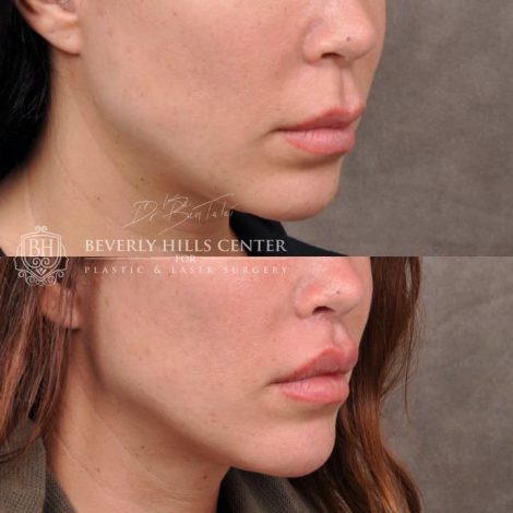 Deep Plane Lip Lift AKA Modified Upper Lip lift - Right Side