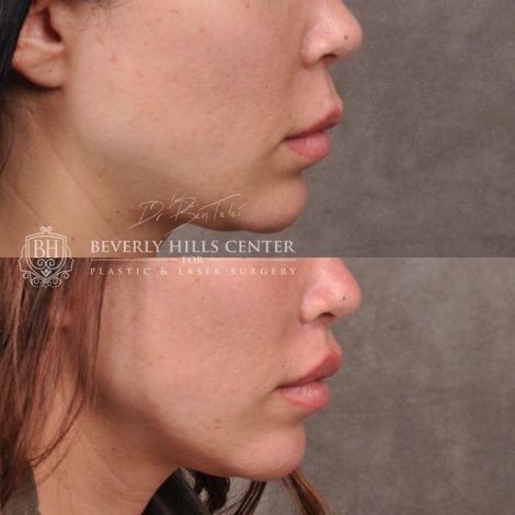 Deep Plane Lip Lift AKA Modified Upper Lip lift - Right Side