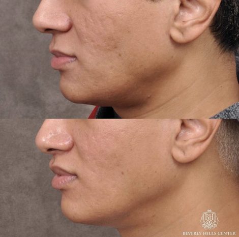 Modified Upper Lip Lift with Deep Plane Release - Left Side