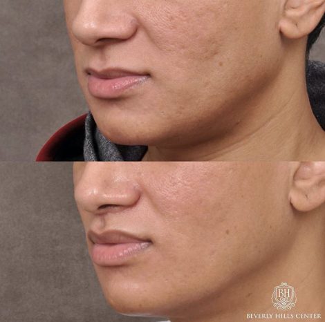 Modified Upper Lip Lift with Deep Plane Release - Left Side